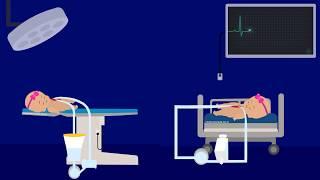 Pediatric CPB VS ECMO