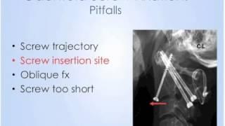 Spine: Odontoid Fractures Anterior Treatment