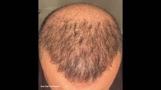 Hair Transplant result in 5 months - 4300 graft