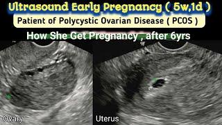 Polycystic Ovaries ( PCOS ) - How she Got Pregnancy ?? | TVS Ultrasound