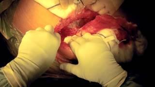 Metal on metal hip replacement revision surgery