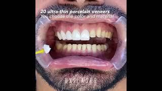 Porcelain veneers. This is how we do it