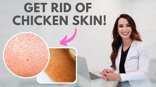 How to Get Rid of CHICKEN SKIN! Keratosis Pilaris treatment! | Dr. Bartos Dermatology