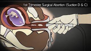 Abortion Procedures 1st, 2nd, and 3rd Trimesters