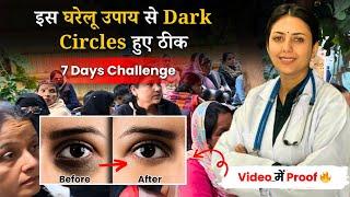 7 Days Dark Circles Challenge - आँखो के केल घेरे हटाए इस Remedy से | Remove Dark Circles Permanently