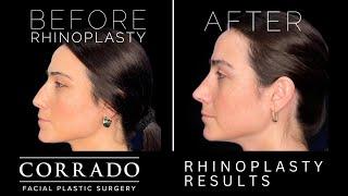 Rhinoplasty Results: Before & After Video | Dr. Anthony Corrado