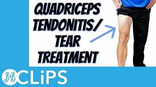 Quadriceps Tendonitis or Tear: Single Best Treatment You Can Do Yourself (60 Sec Video)