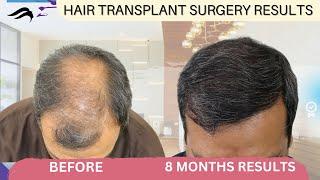 Hair Transplant In Kerala | Best Results Surgeon Hospital & Cost Of Hair Transplant In Kerala