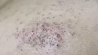 Blackhead Removal | 1 | Blackhead extraction | #blackheads