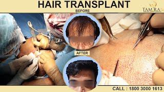 Live FUE Hair Transplant Surgery in Chennai @TamiraLife