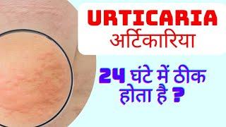 urticaria in hindi | urticaria treatment in hindi | hives on skin | urticaria symptoms