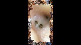 Blackhead Removal | 25 | Ear Blackhead | #blackheads