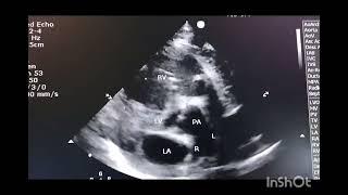 Transposition of great vessels on Echocardiography