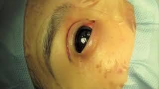 Asian Upper Blepharoplasty