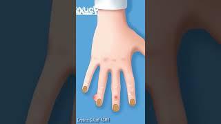 Acne Removal and nail care #amsr #satisfying #oddlysatisfying #animation