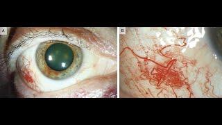 Okkuläre Befunde bei Sturge–Weber Syndrome