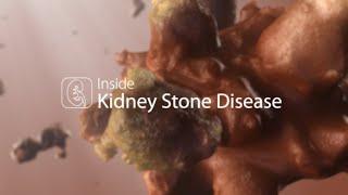 Medical Animation: Kidney Stone Disease