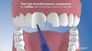 Estética Dental - Carillas - Vitaldent