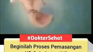 Proses pemasangan IUD