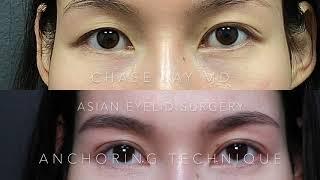 Asian eyelid surgery Anchoring Chase Lay MD 2020