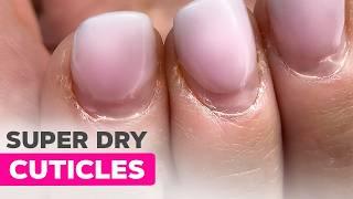 E-file Manicure for Overgrown Cuticles | Encapsulated Glitter French Tips