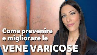 Come prevenire e migliorare le vene varicose in modo naturale