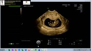 TRISOMI 21 - NUCHAL EDEMA TEBAL - HYDROPS FETALIS  12 WEEKS (Dr Wiku Andonotopo)