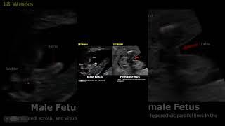 Fetal Gender Determination Ultrasound | 18-19 Weeks Male & Female | Baby Boy/Girl Sex USG #shorts