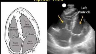 How to: Cardiac Ultrasound - Apical View Case Study