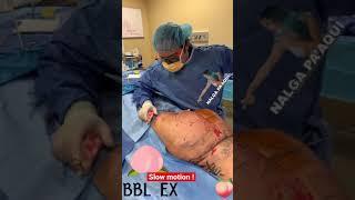 Brazilian butt lift in action ! | Dr Jeneby Slow motion bbl