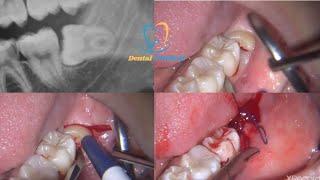 Surgical Extraction Of a Mesioangular impacted third molar