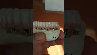 Növbəti uğurlu implant üstü metal keramika işimiz #dentist #cadcamdentistry #keşfet