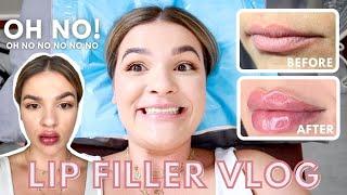 GETTING MY LIPS DONE  | MY LIP FILLER EXPERIENCE BEFORE AND AFTER 