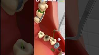 teeth cleaning by animation | treatment animation video #kidsvideo #animationvideo #drgame #short