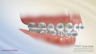 Elastics - Class II Box - Orthodontic Treatment