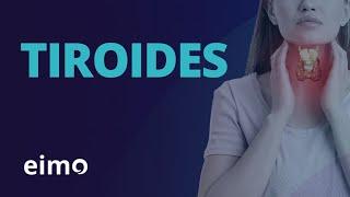 Tiroides | Tiroiditis de Hashimoto