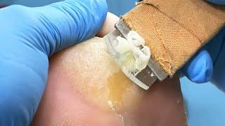 Thick calluses on soles of feet, trimmed easily by doctors【Pedicure Master Lin Jun】