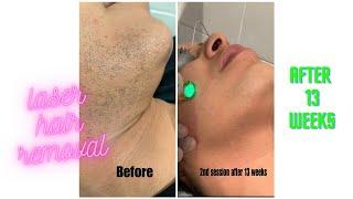 Laser treatment 2nd session | how to carry out laser hair removal