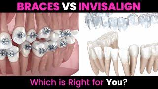 Braces VS Invisalign : Which Is Better?