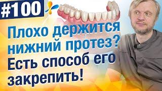 Закрепить нижний зубной протез на имплантах. Цена? Почему это самый удобный способ крепления?