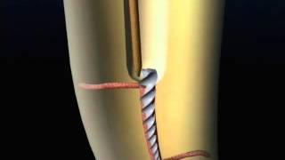 Removal of separated instrument with ultrasonics | Dentsply Sirona