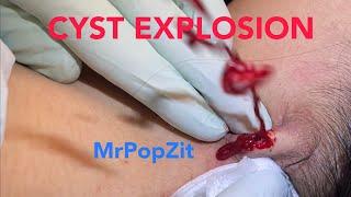 Juicy cyst explosion.MrPopZit gets popped. Neck abscess I+D under pressure, removed, flushed, packed