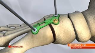 ORTHOLOC™ 3Di Foot Reconstruction System Lapidus Plate Animation