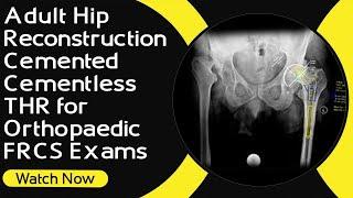 Adult Hip Reconstruction | Cemented / Cementless THR  for Orthopaedic FRCS Exams