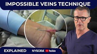 Difficult veins - Made Much Easier with this technique!