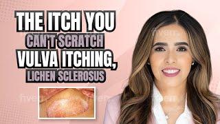 The Itch You Can’t Scratch. Vulvar Itching, Lichen Sclerosus