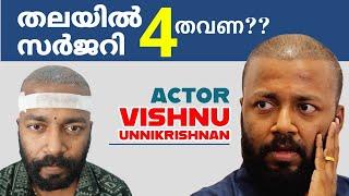 Actor Vishnu Unnikrishnan തലയിൽ ചെയ്ത നാലാമത്തെ സർജറിയും  ഫെയിൽ  ആയോ  La Densita Hair Clinic Kerala