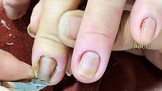 Inflamed Nails, Need to Remove Corners, Pick Dead Skin, Nail Spa