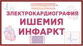 ЭКГ - инфаркт и ишемия