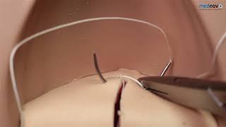 How to repair an episiotomy or 1st & 2nd degree Perineal tear